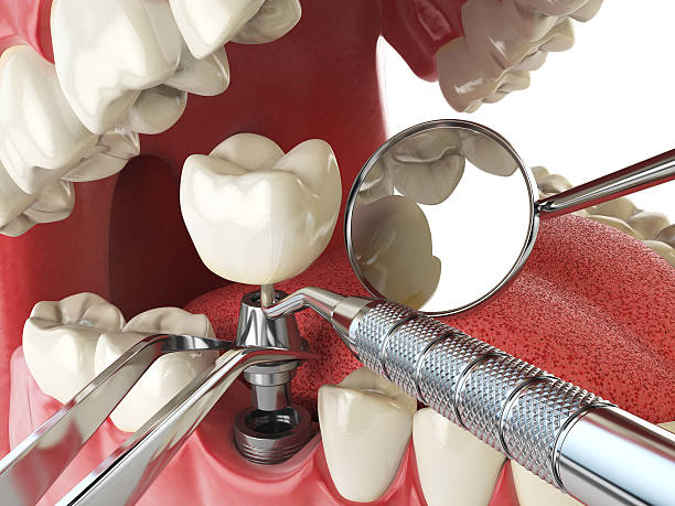 Best Emergency Tooth Extraction in Anna, IL