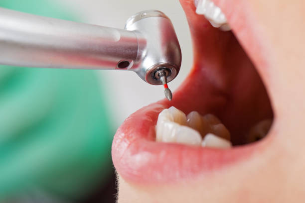 Best Emergency Tooth Extraction in Anna, IL